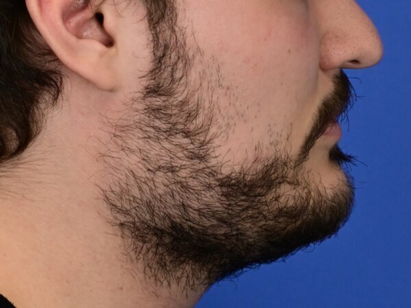 Renuvion Skin Tightening Before & After Image