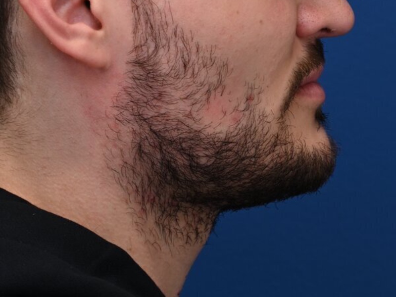 Renuvion Skin Tightening Before & After Image