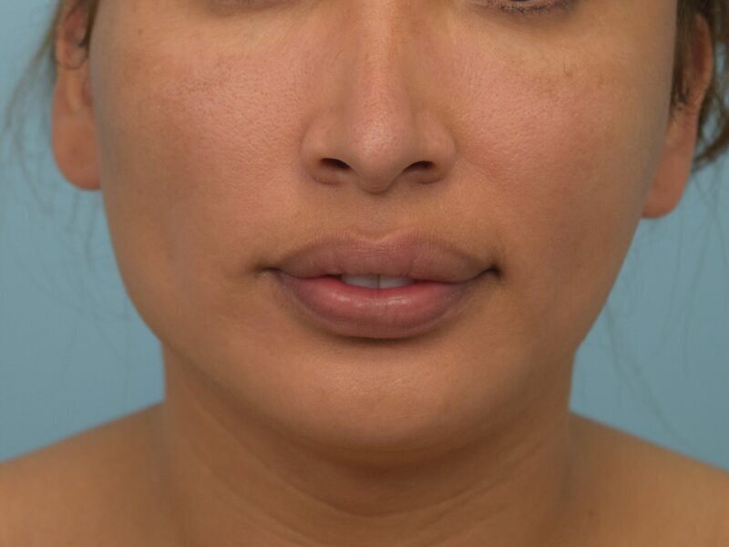 Renuvion Skin Tightening Before & After Image
