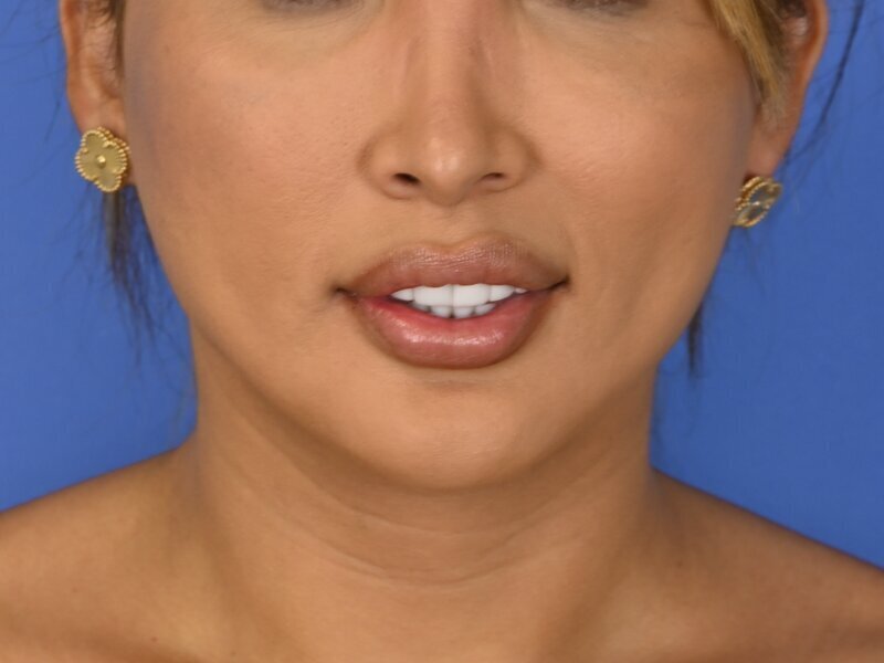 Renuvion Skin Tightening Before & After Image