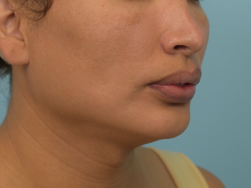 Renuvion Skin Tightening Before & After Image