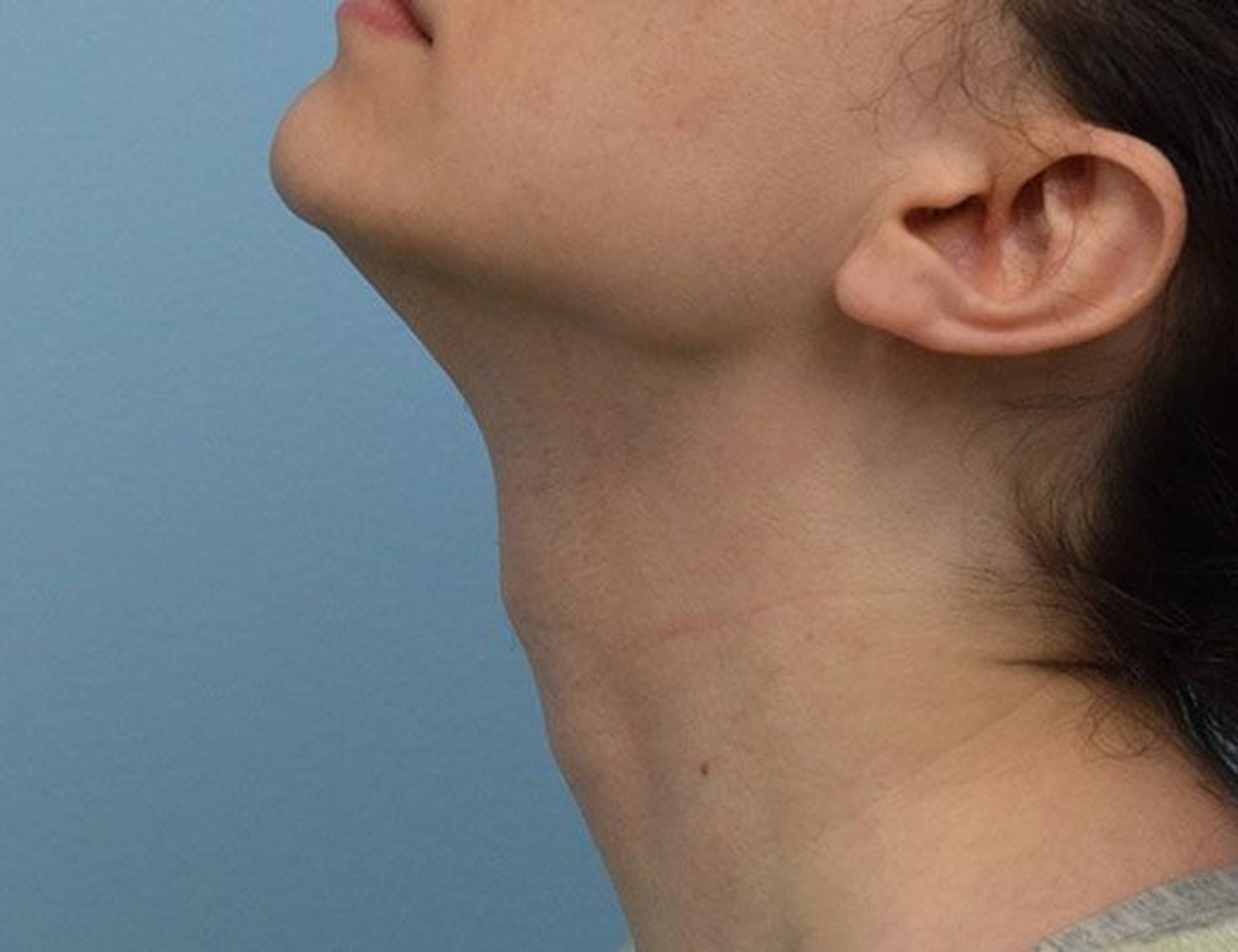 Tracheal Shave Before & After Image