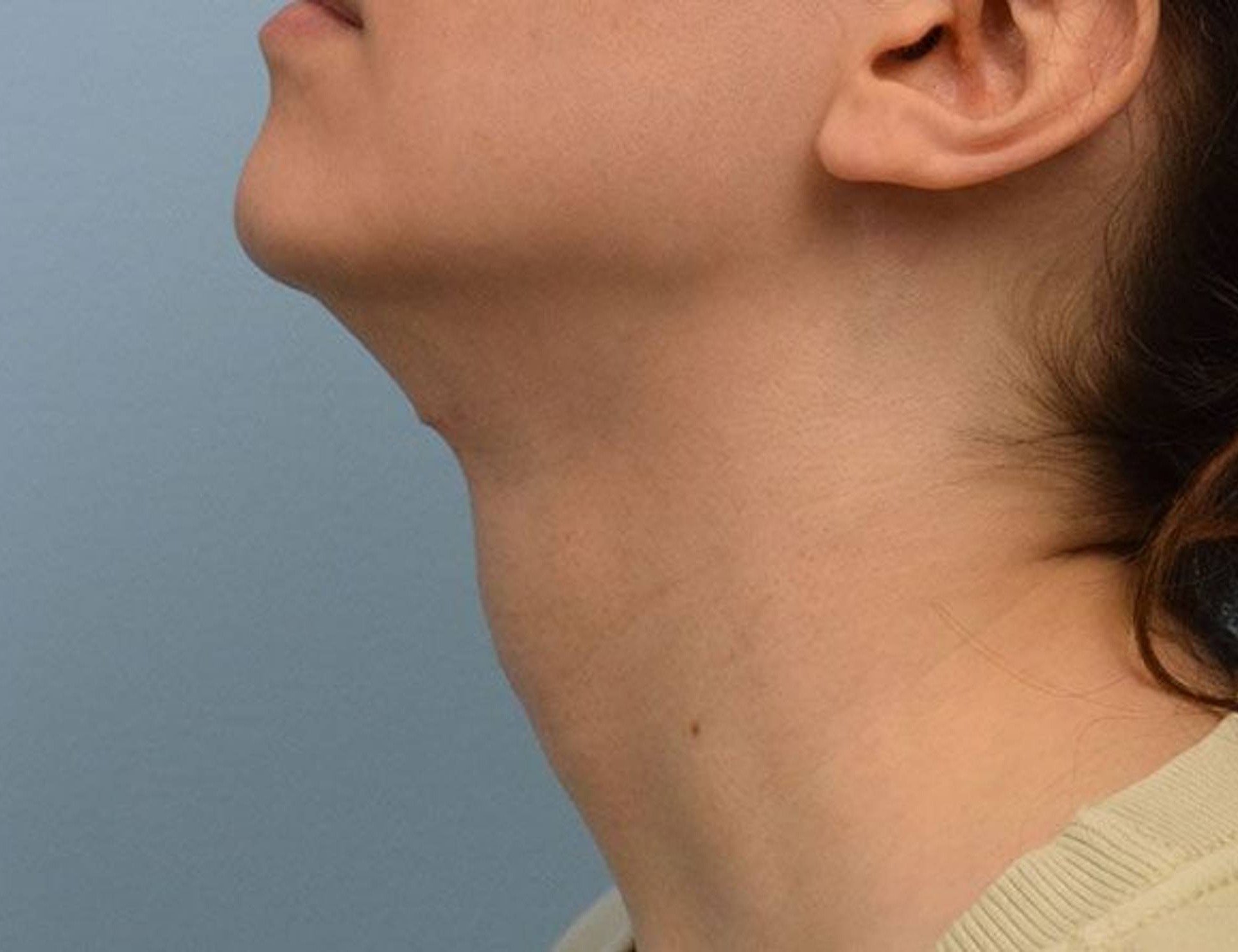 Tracheal Shave Before & After Image