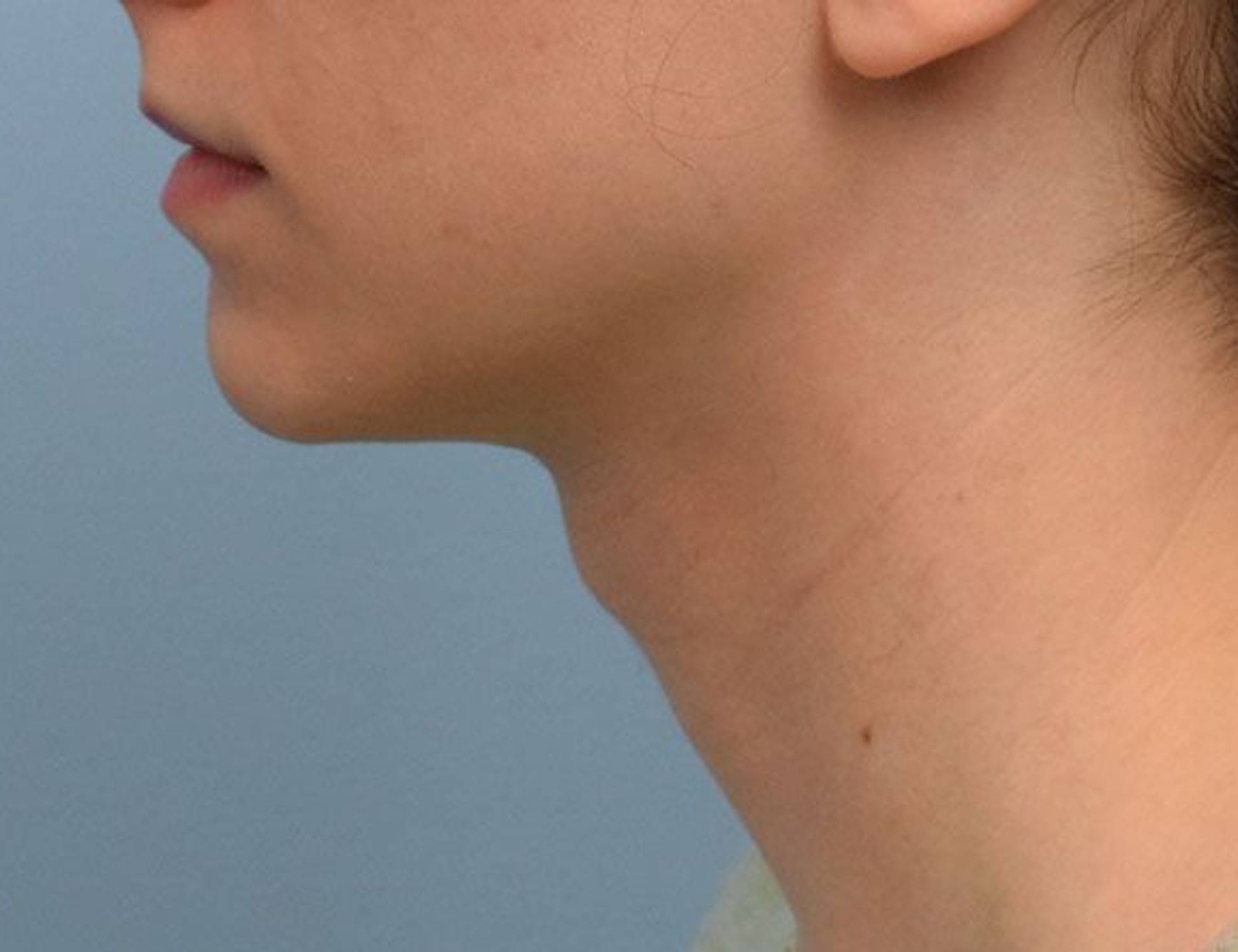 Tracheal Shave Before & After Image