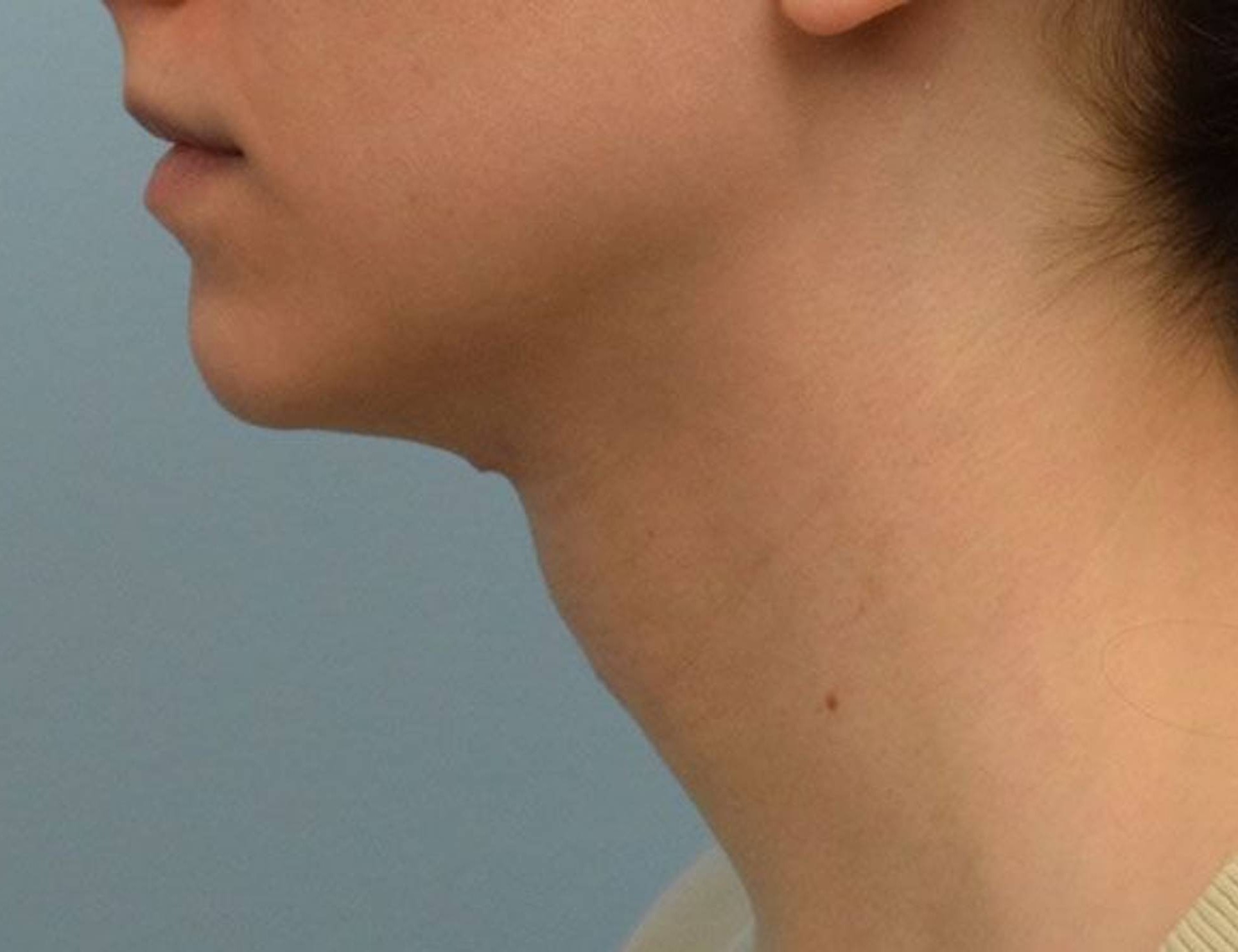 Tracheal Shave Before & After Image