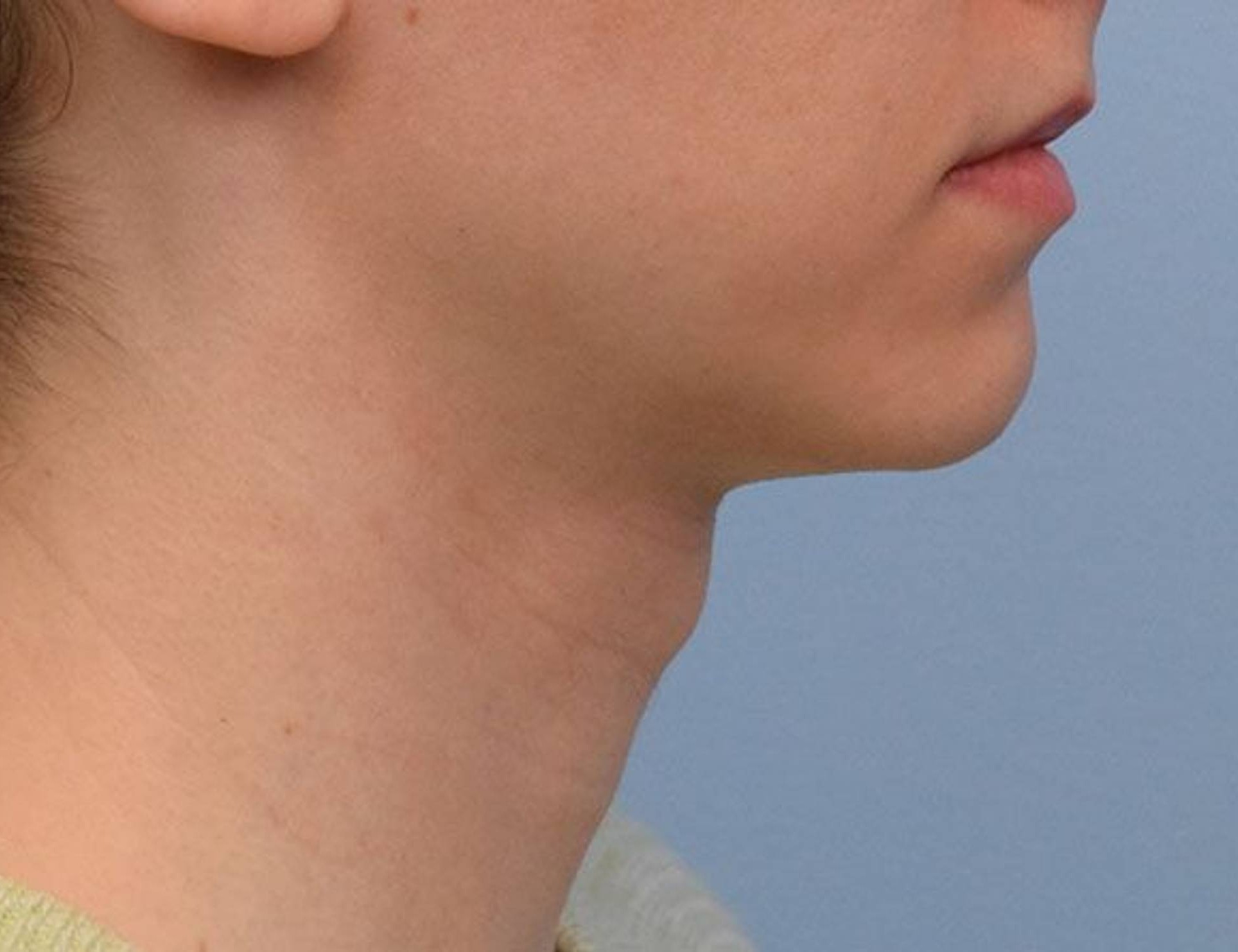 Tracheal Shave Before & After Image