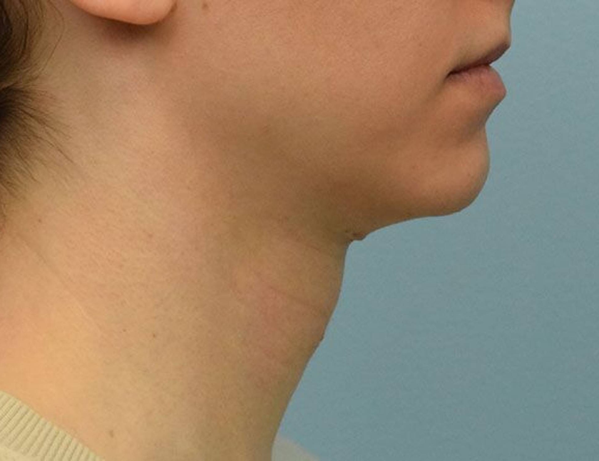 Tracheal Shave Before & After Image