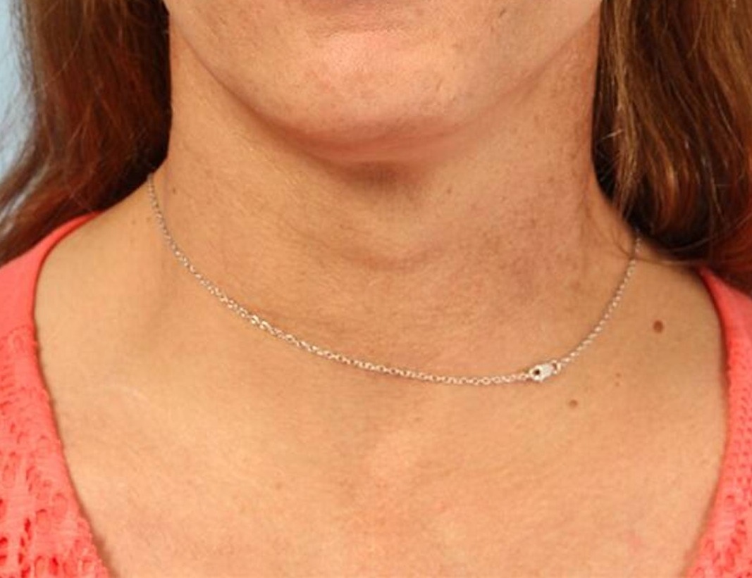 Tracheal Shave Before & After Image