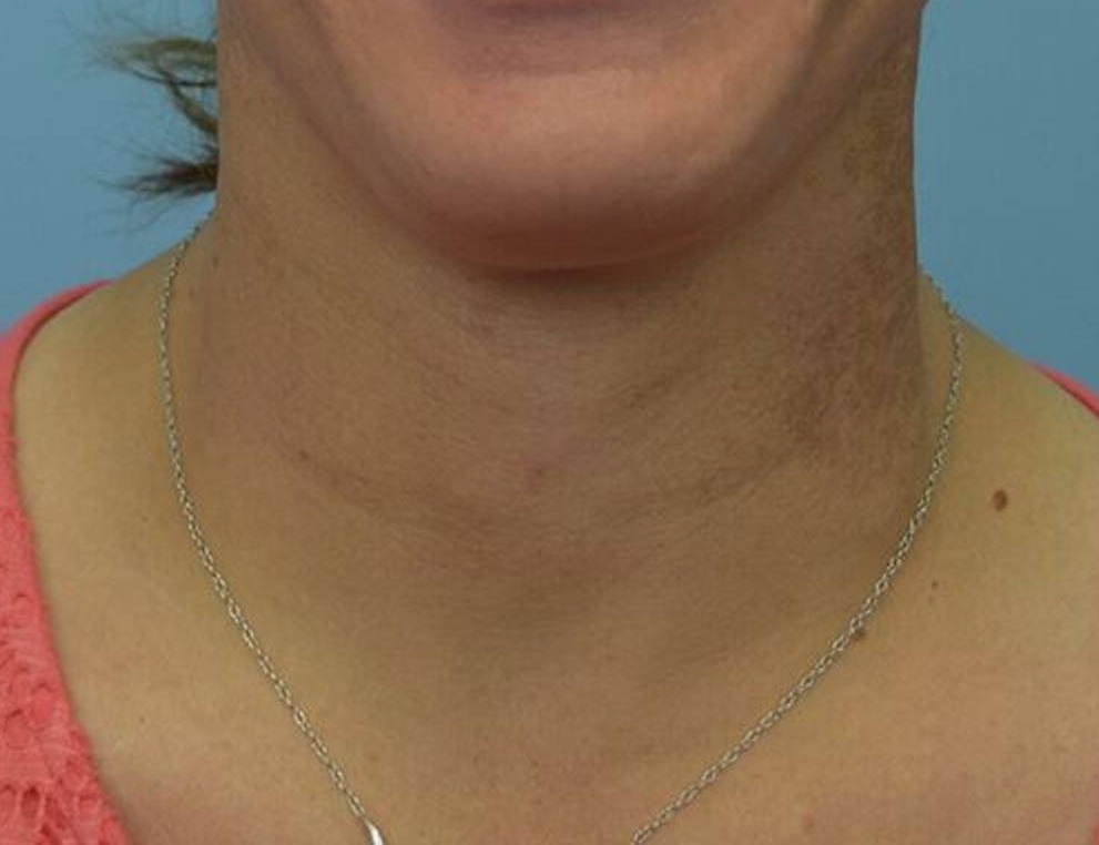 Tracheal Shave Before & After Image