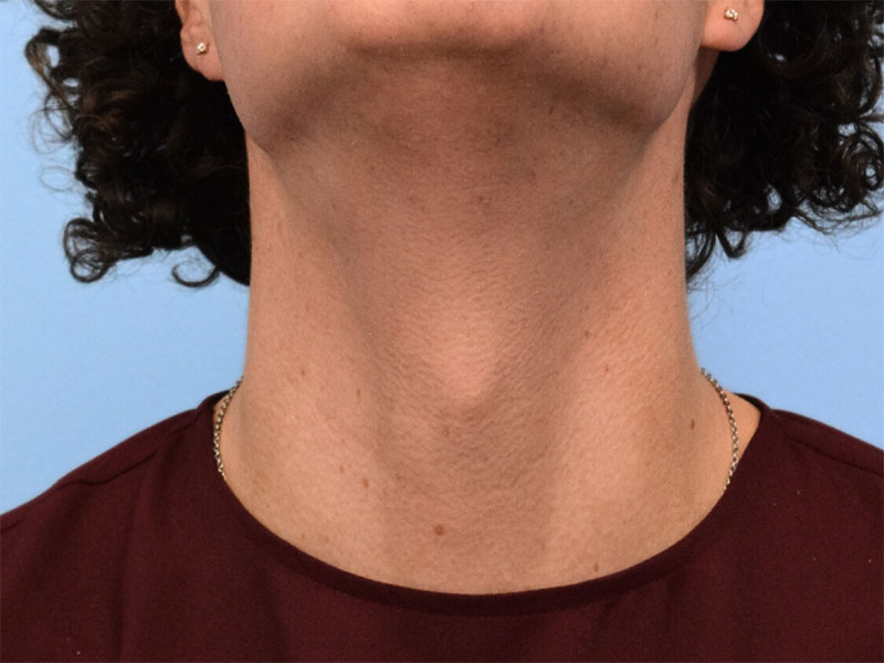 Tracheal Shave Before & After Image