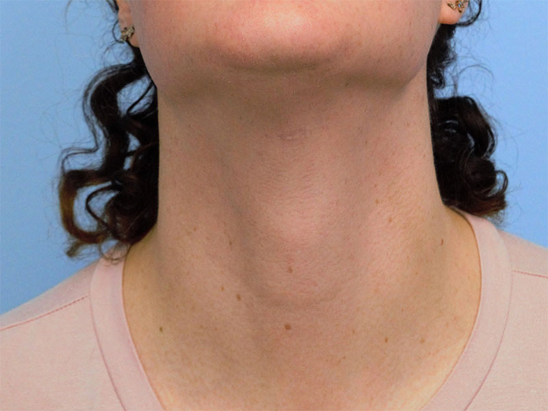 Tracheal Shave Before & After Image