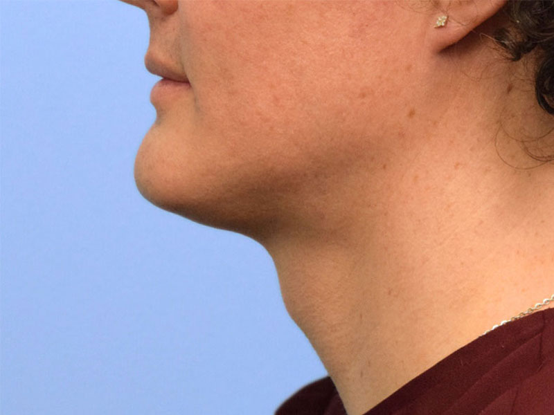 Tracheal Shave Before & After Image