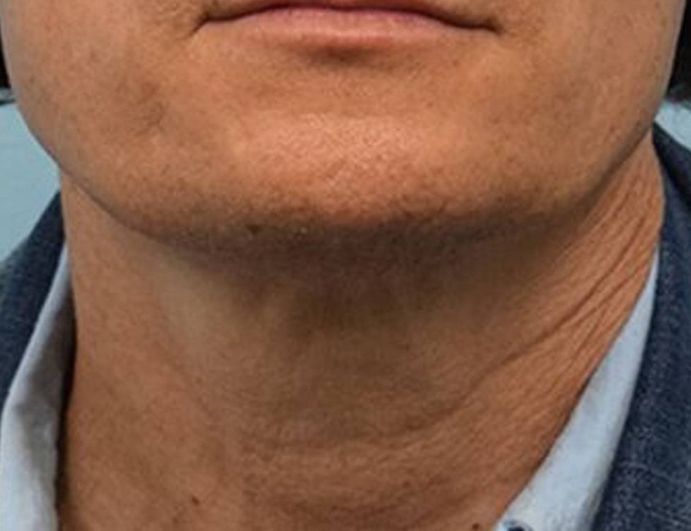 Tracheal Shave Before & After Image