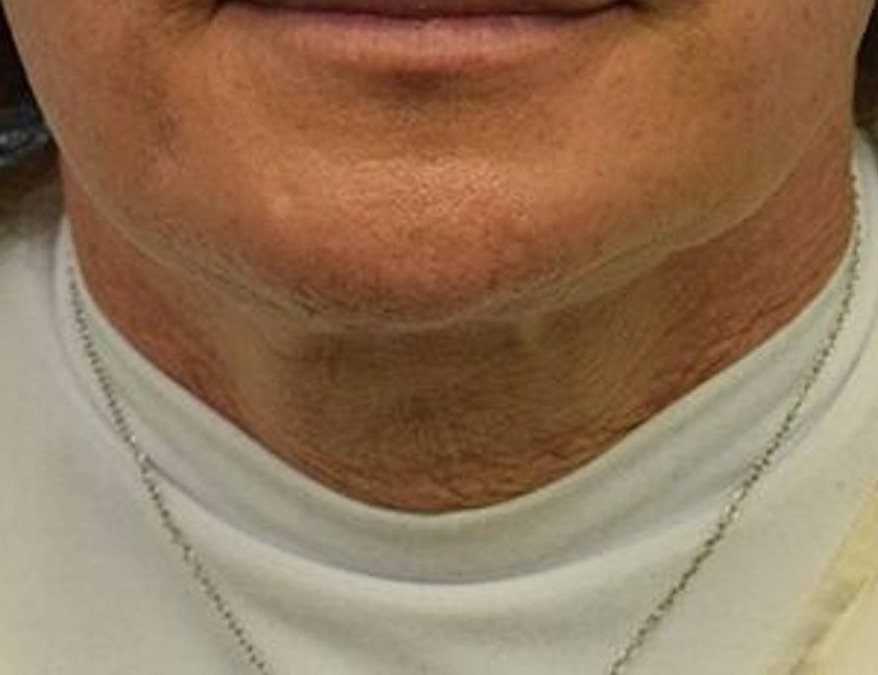 Tracheal Shave Before & After Image