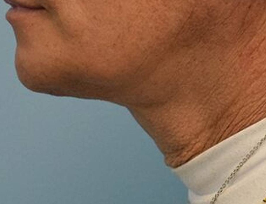 Tracheal Shave Before & After Image