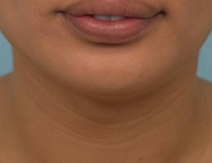 Tracheal Shave Before & After Image