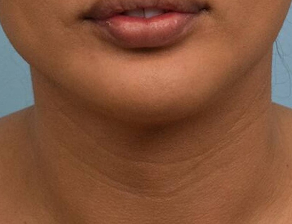 Tracheal Shave Before & After Image