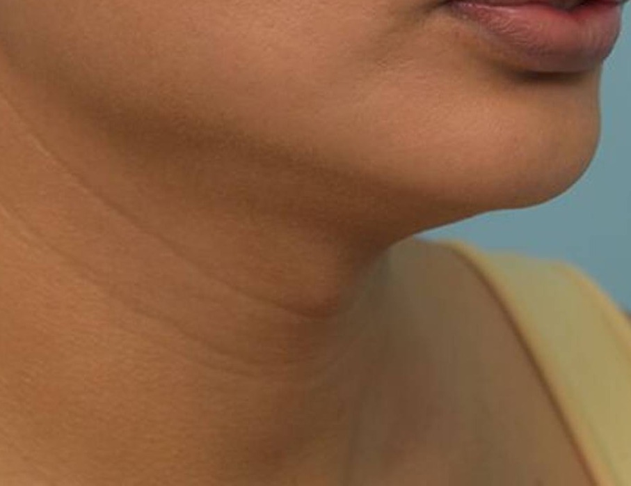 Tracheal Shave Before & After Image