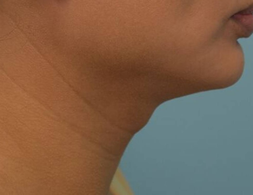 Tracheal Shave Before & After Image