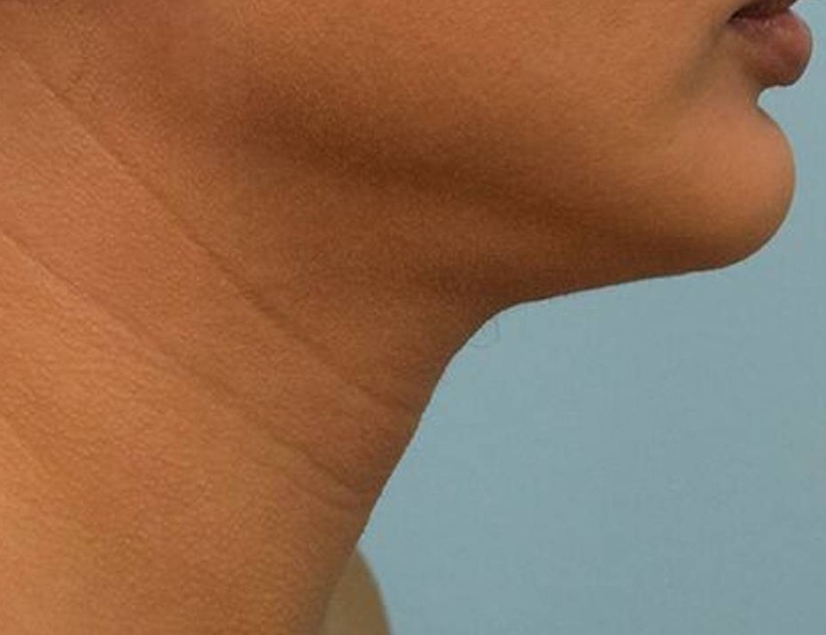 Tracheal Shave Before & After Image