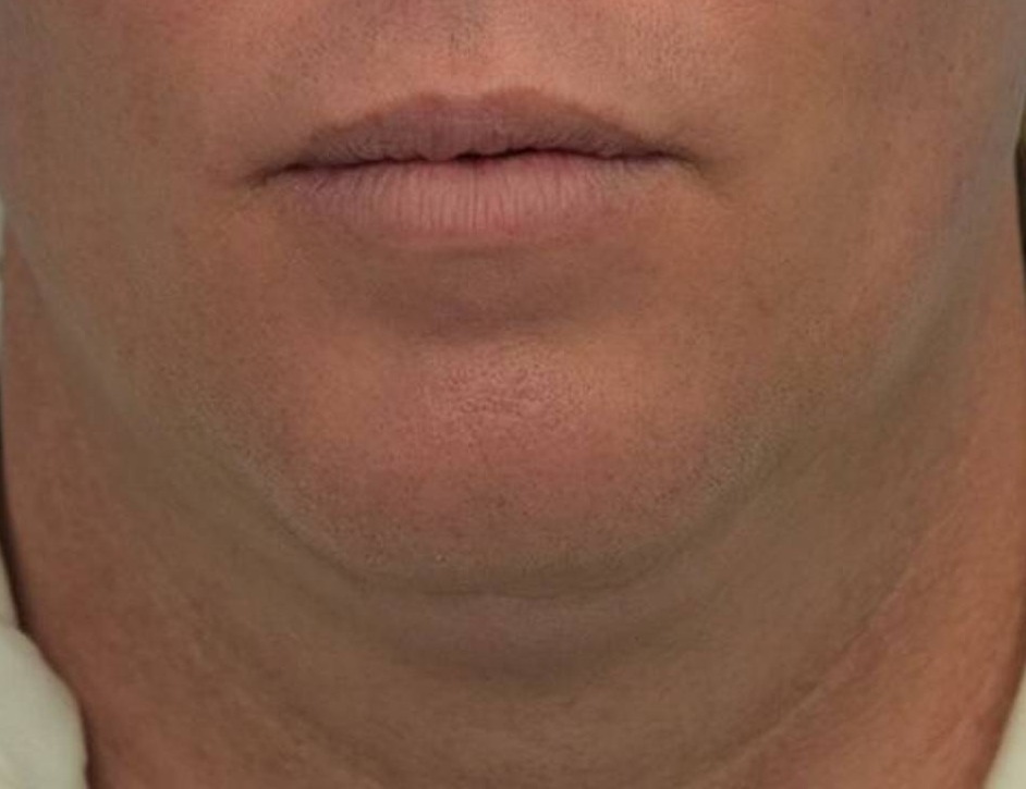 Tracheal Shave Before & After Image