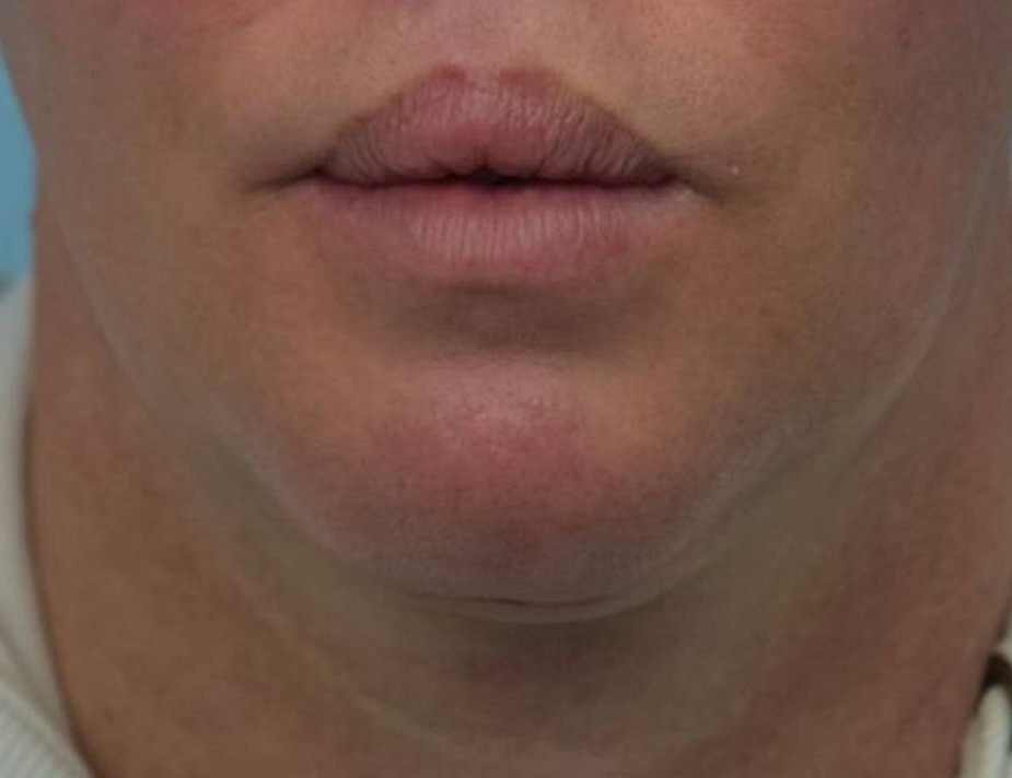 Tracheal Shave Before & After Image