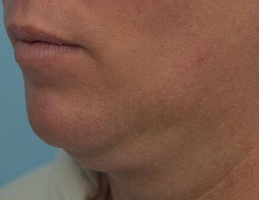 Tracheal Shave Before & After Image