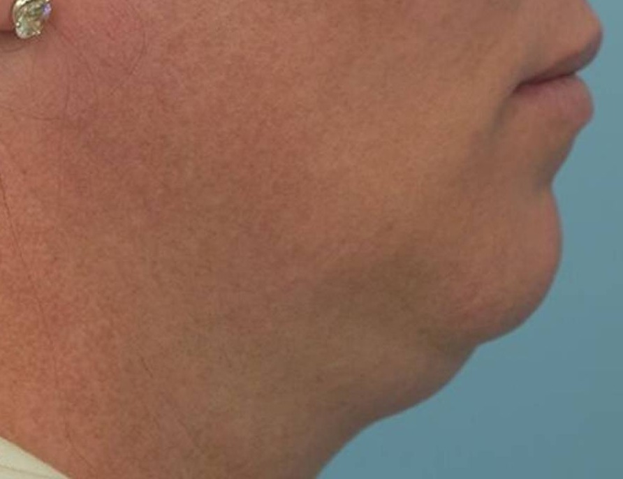 Tracheal Shave Before & After Image