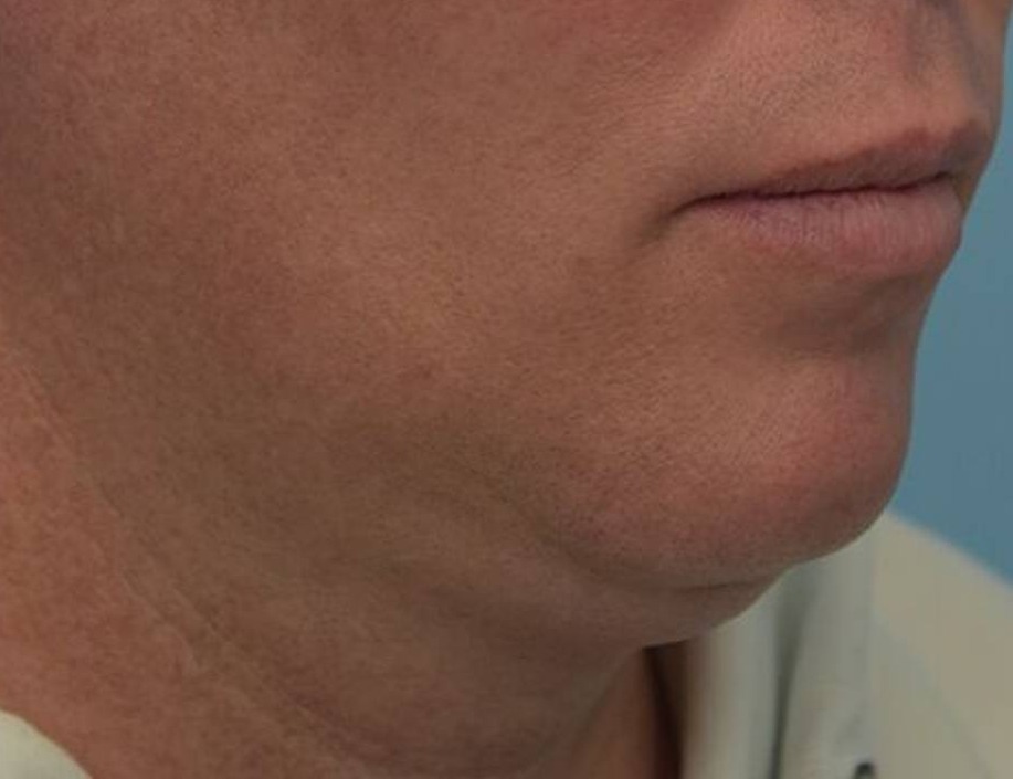 Tracheal Shave Before & After Image