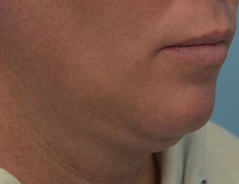 Tracheal Shave Before & After Image