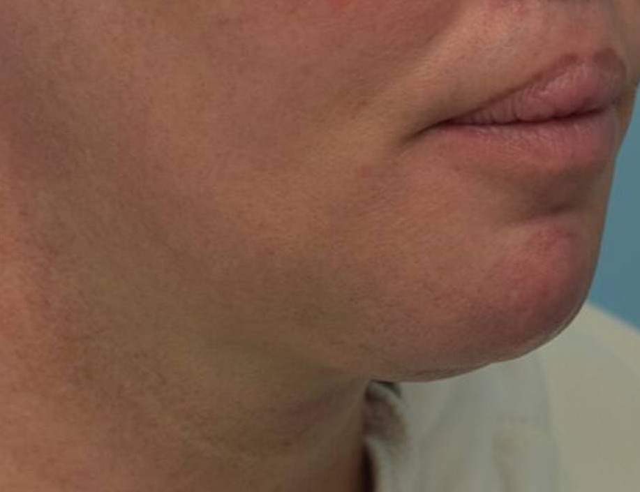 Tracheal Shave Before & After Image