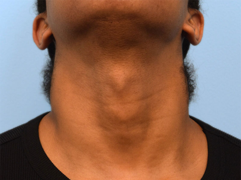 Tracheal Shave Before & After Image