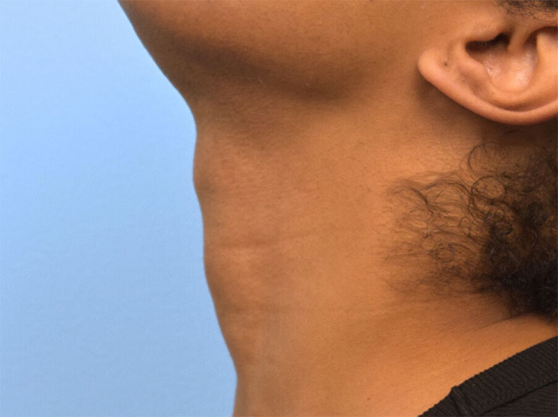 Tracheal Shave Before & After Image