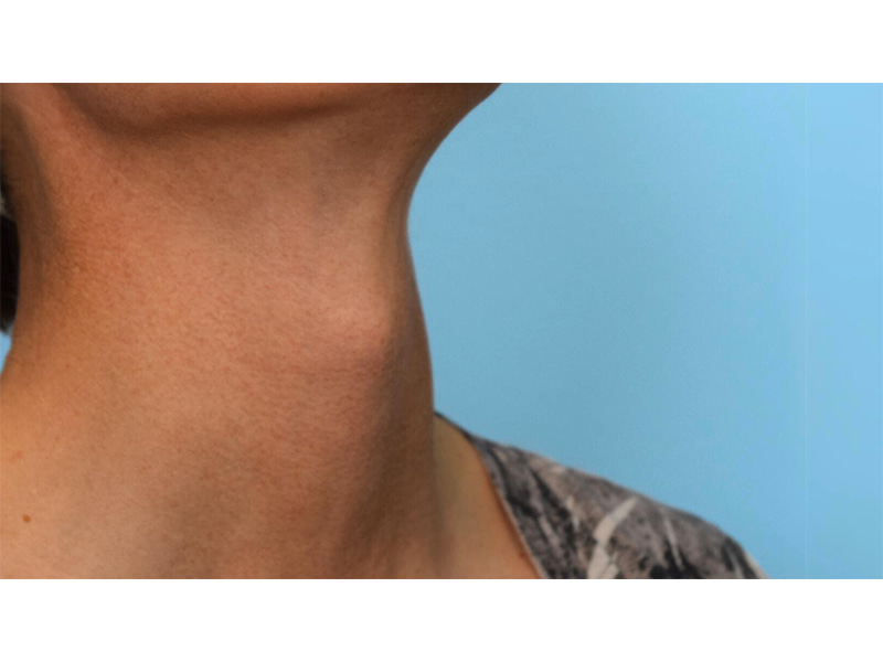 Tracheal Shave Before & After Image