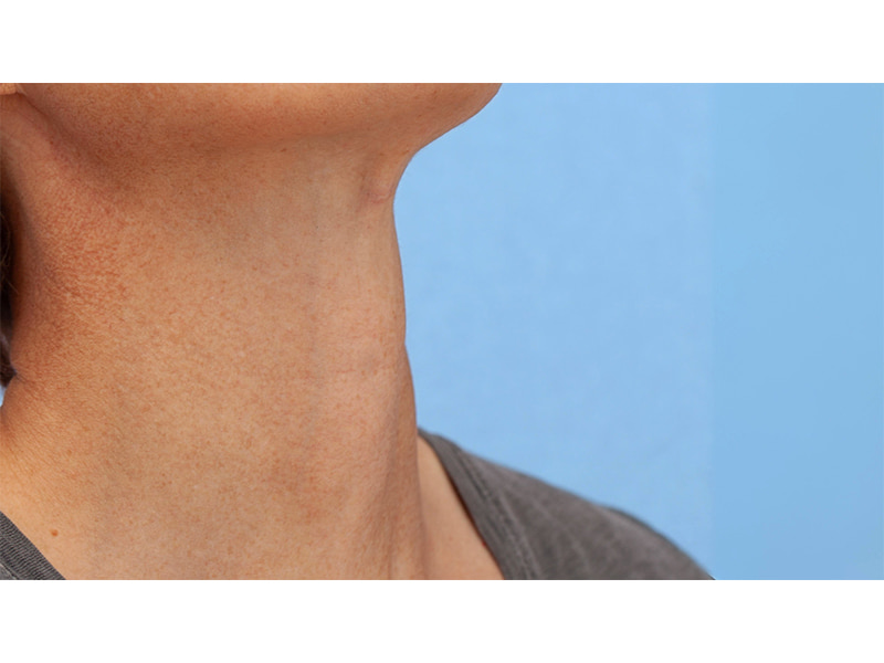 Tracheal Shave Before & After Image