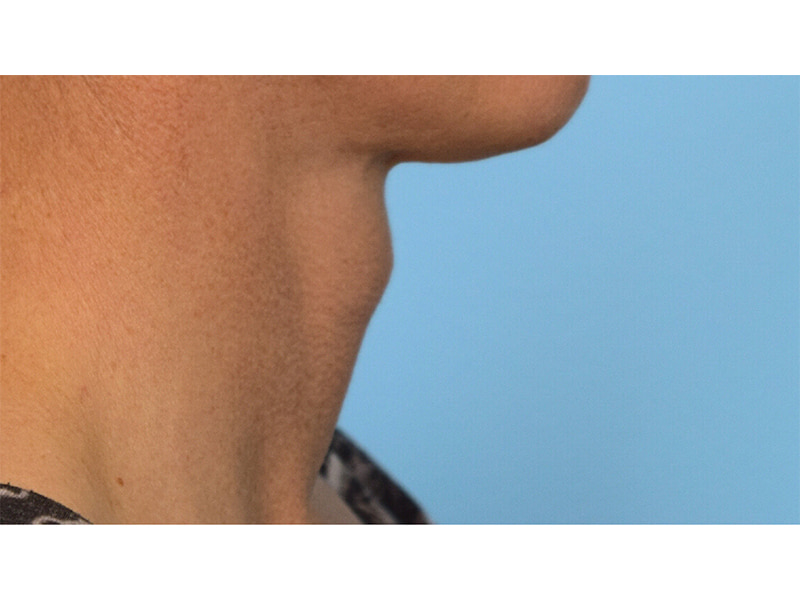 Tracheal Shave Before & After Image