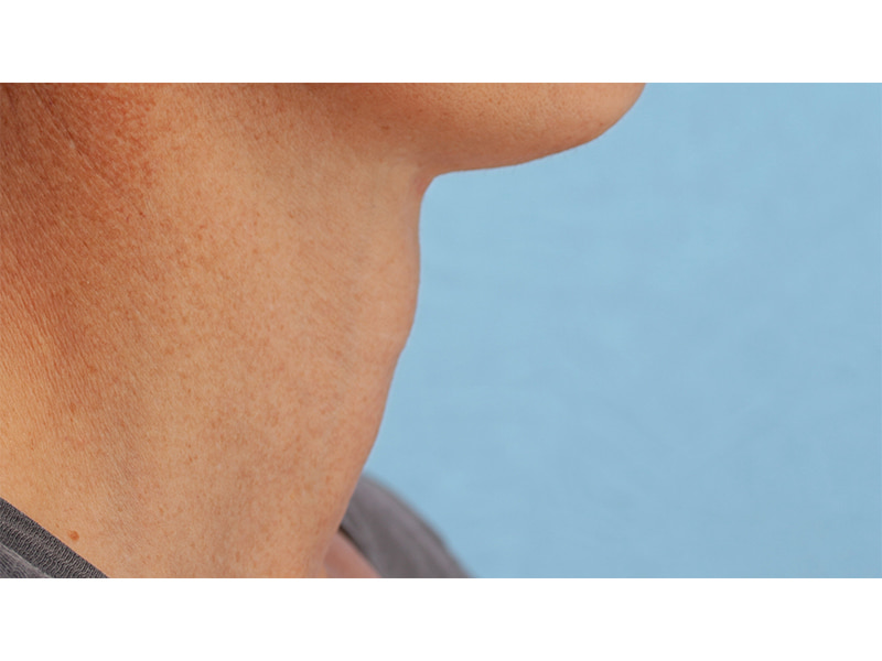 Tracheal Shave Before & After Image