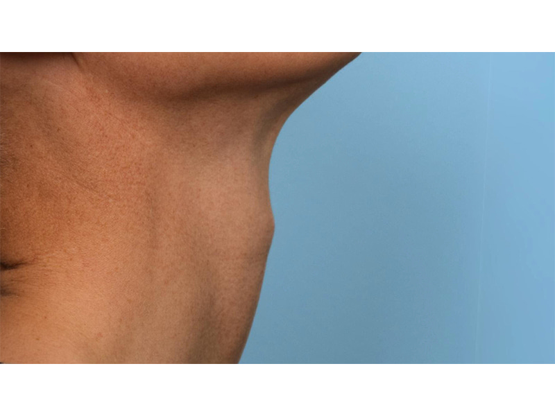 Tracheal Shave Before & After Image