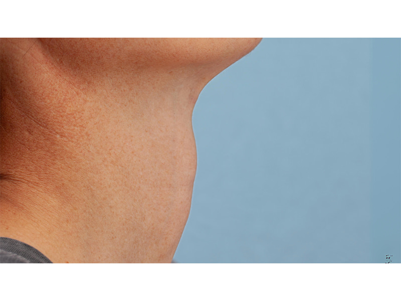 Tracheal Shave Before & After Image