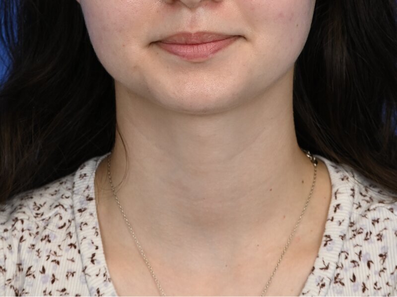 Tracheal Shave Before & After Image