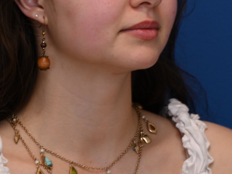 Tracheal Shave Before & After Image