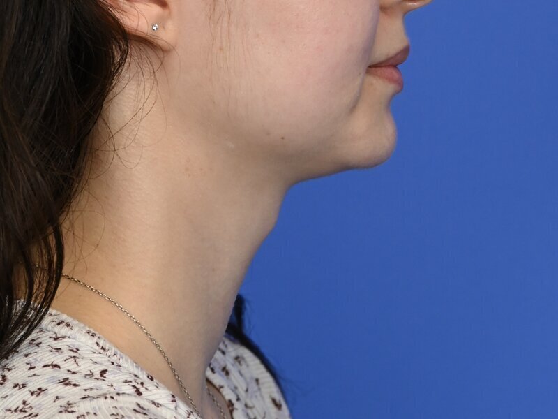 Tracheal Shave Before & After Image