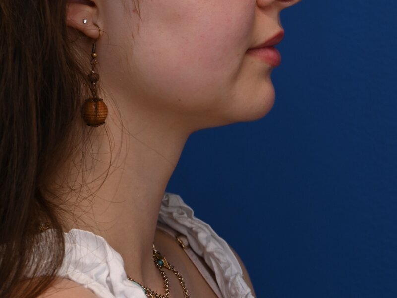 Tracheal Shave Before & After Image