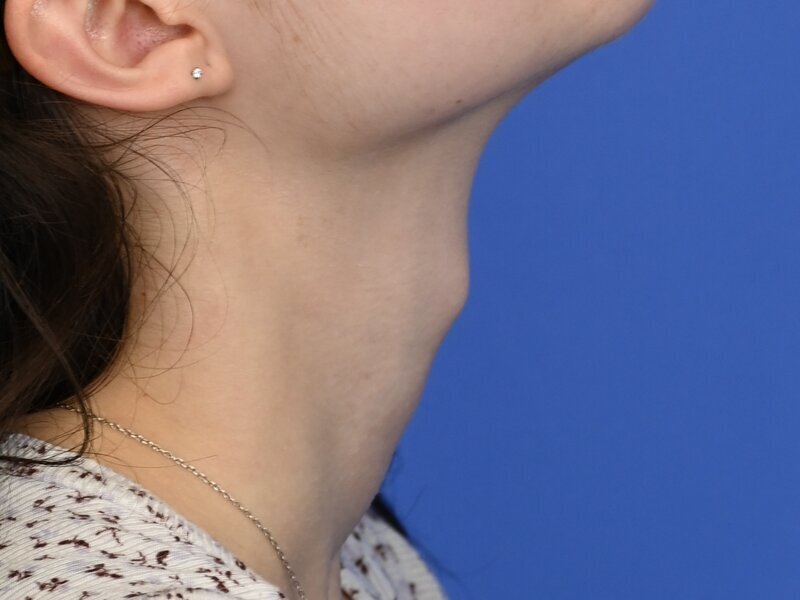 Tracheal Shave Before & After Image