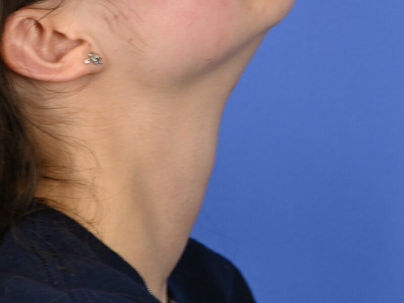 Tracheal Shave Before & After Image