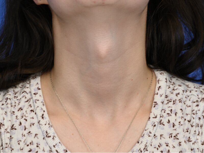 Tracheal Shave Before & After Image