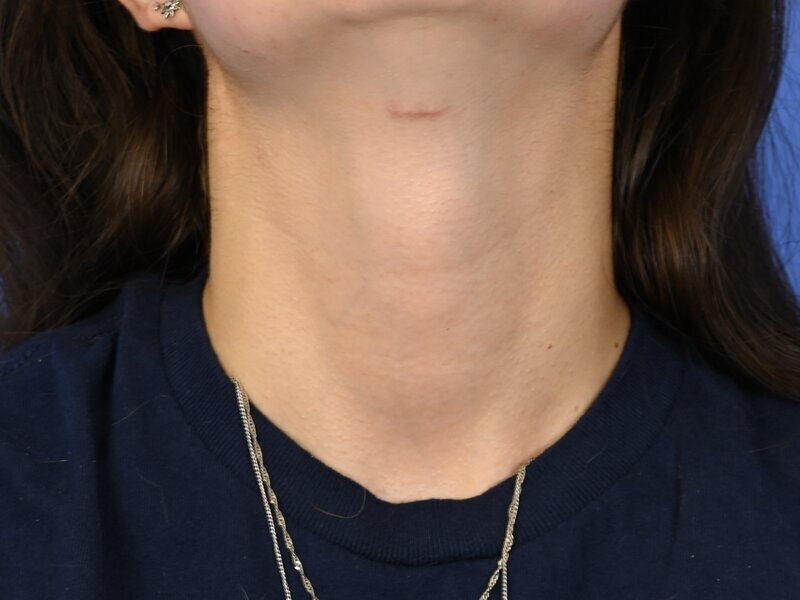 Tracheal Shave Before & After Image