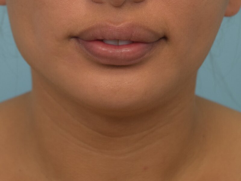 Tracheal Shave Before & After Image