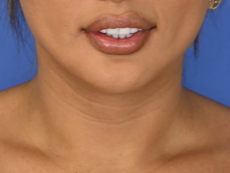 Tracheal Shave Before & After Image