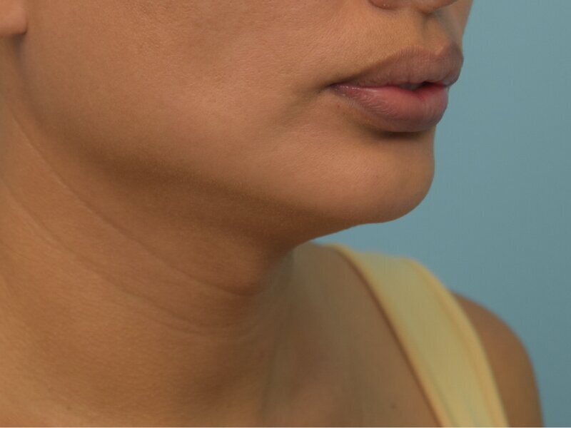 Tracheal Shave Before & After Image